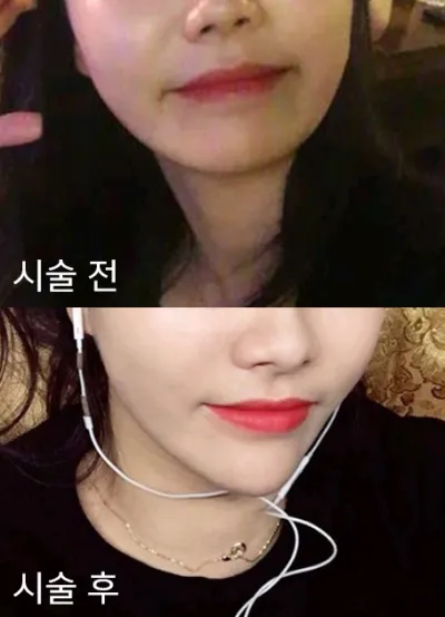 [微整形] 얄라숑쓰 - 下巴填充