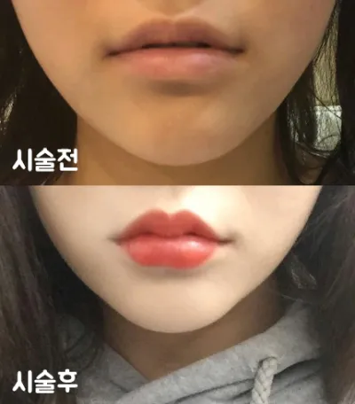 [微整形] bobommm - 嘴唇填充