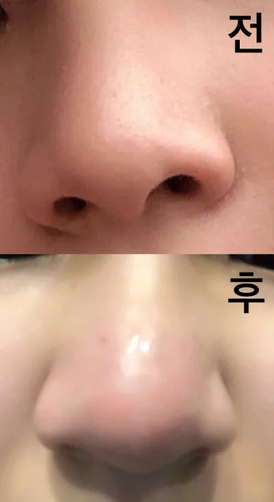 [微整] 豐唇 - 鼻雕塑注射