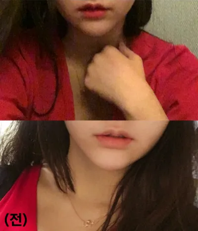 [微整形] ghyghy - 嘴唇填充