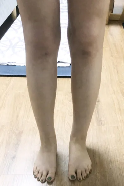 [抽脂] 꿀타빈 - 小腿、腹部抽脂