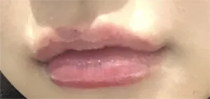 [微整形] 무하니 - 嘴唇