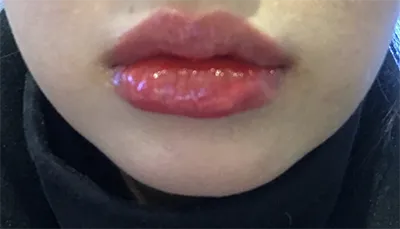 [微整形] 앙꼬 - 嘴唇