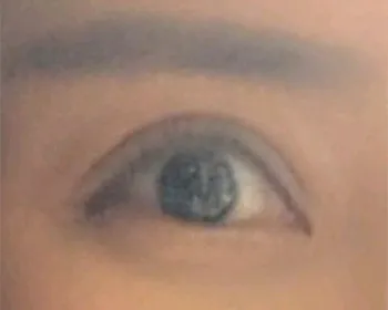 [微整形] 如星星般閃耀 - 填充劑