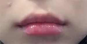 [微整形] 娜샛별 - 嘴唇