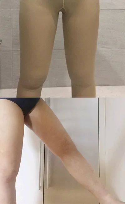 [抽脂] 꺅긱꺅 - 抽脂