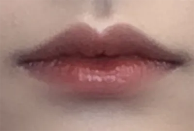 [微整形] ㄷㄷㄷ - 嘴唇