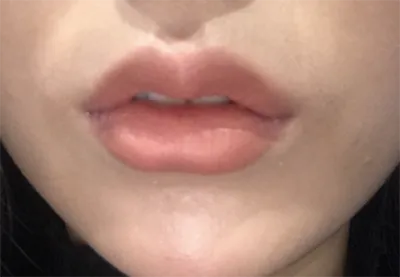 [微整形] lil887 - 嘴唇