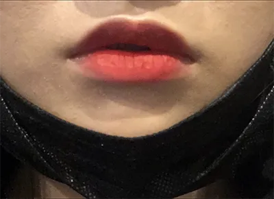 [微整] 林米 - 嘴唇