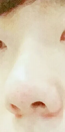 [微整形] 鄭大勳 - 鼻子