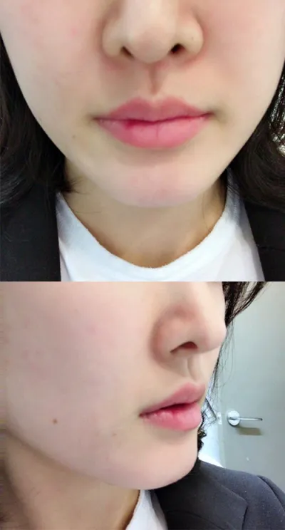 [微整形] 紅紅桃桃 - 嘴唇填充