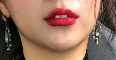 [微整形] 麗*娜 - 嘴唇填充