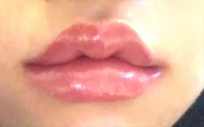 [微整形] 嘴唇1910 - 嘴唇