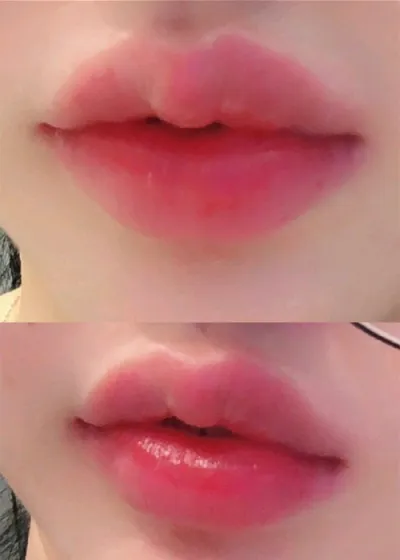 [微整形] 尹尹尹尹尹尹2 - 豐唇玻尿酸