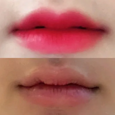 [微整形] sodh - 豐唇填充