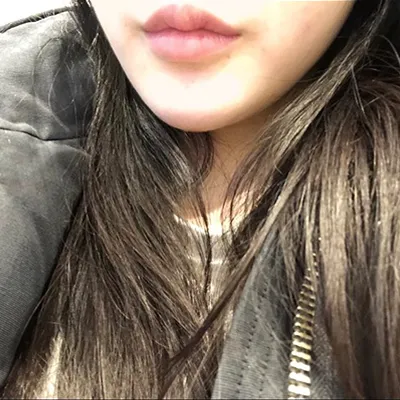 [微整形] yghvj - 下巴