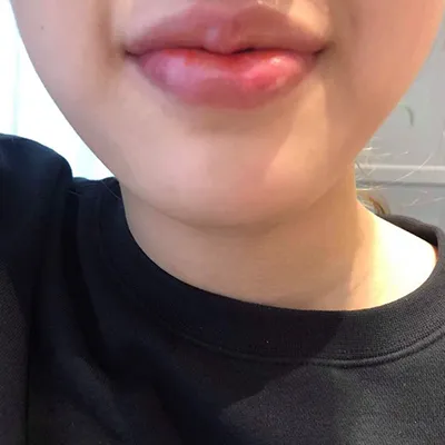 [微整形] zxoy030 - 嘴唇