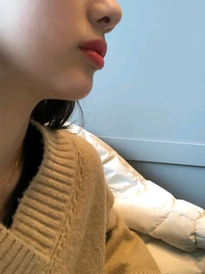 [微整形] fdksk - 下巴填充