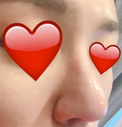 [微整形] 2080齒呀酷 - 鼻雕注射、肉毒桿菌