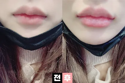 [微整] 嚶嚶嚶 - 嘴唇填充