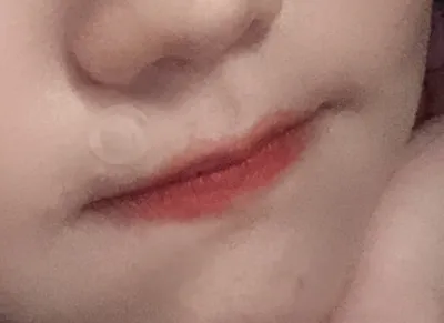 [微整] vv林b27 - 嘴唇填充