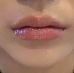 [微整形] 西羅人 - 嘴唇