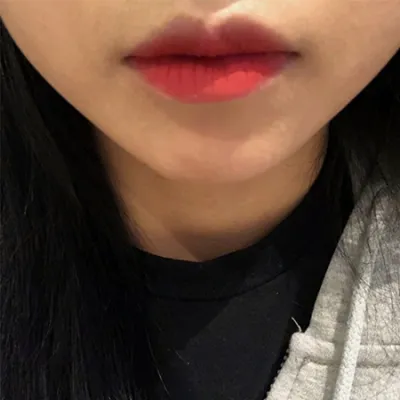 [微整] 李1쁘듀 - 嘴角填充、肉毒桿菌