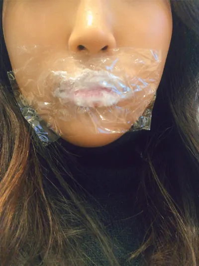 [微整形] hyb - 嘴唇填充劑、肉毒桿菌