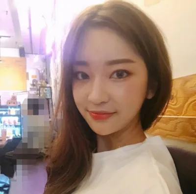 [眼部] 메이123 - 眼部手術、脂肪移植