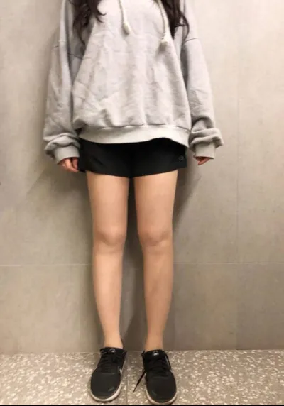 [抽脂] 呀吼呀吼 - 抽脂