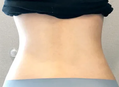 [抽脂] 꿀타빈 - 小腿、腹部抽脂