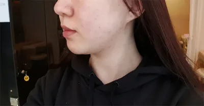 [皮膚] 白玉棉花糖 - 音波拉提400發