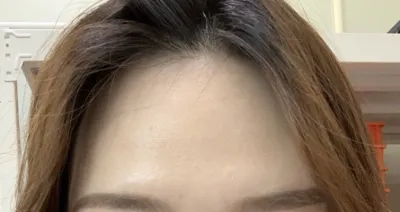 [抗衰老] 這是我~~ - 額頭脂肪移植