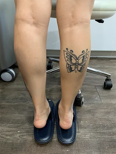 [微整形] 제니03 - 小腿