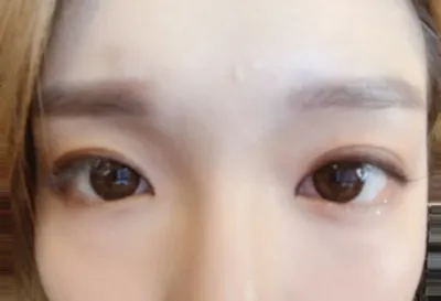 [眼部]整形後記 - 眼部