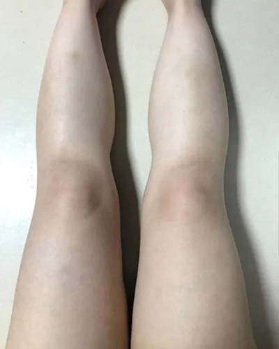 [抽脂] zz0808 - 小腿、大腿抽脂