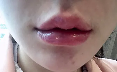 [微整形] 改善唇形 - 嘴唇