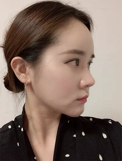 [微整] kiya ho1115 - 拉提