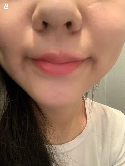 [微整] 莉莉露露 - 嘴唇