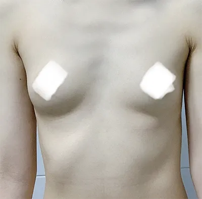 [隆胸] Irokoi - 胸部