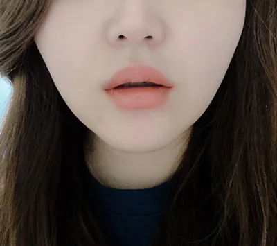 [微整形] Blinlee - 嘴角肉毒桿菌、嘴唇填充