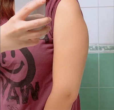 [抽脂] 藍莓勇 - 抽脂