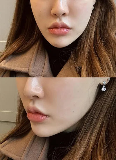 [皮膚] 變漂亮的心願 - 音波拉提、輪廓肉毒