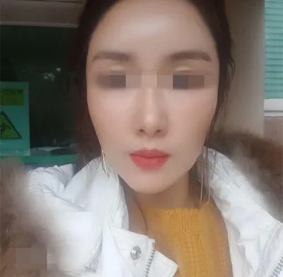 [抗衰老] 彬彬家 - 臉部脂肪移植