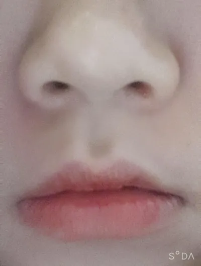 [微整形] ds0405 - 肉毒桿菌