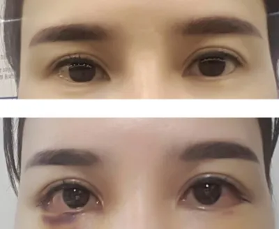 [眼睛] Sangkeumi Girl - 下眼瞼下至、後眼角切開