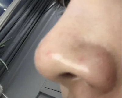 [微整] 민_디 - 鼻雕塑注射