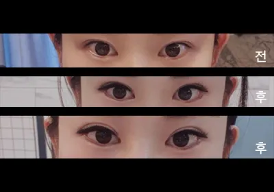 [眼睛] Seo Lovely 9999 - 下眼瞼下至, 後眼角切開