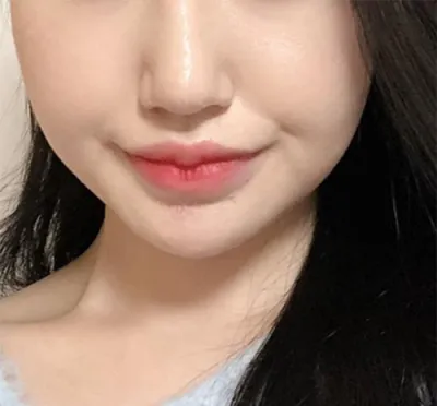 [皮膚] 嘰嘰嘰嘰嘰嘰 - 音波拉提、輪廓肉毒