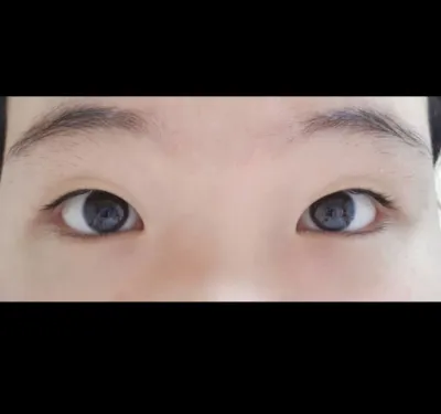 [眼睛] SSUYUYUN - 縫雙眼皮, 開眼頭